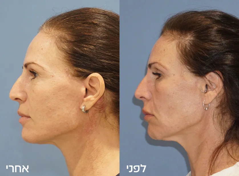 Before-After copy-1