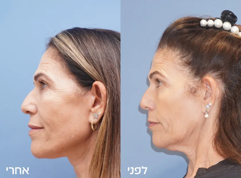 Before-After copy-2
