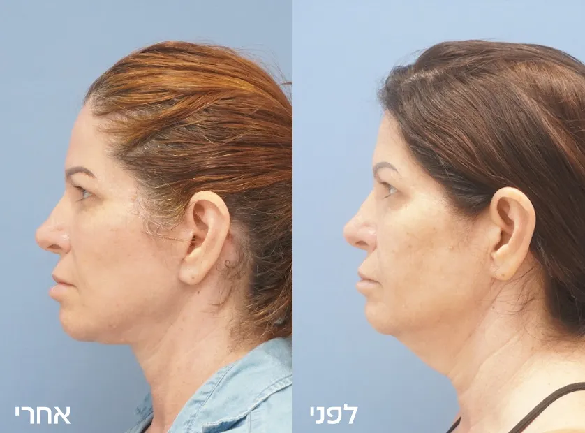 Before-After copy-3
