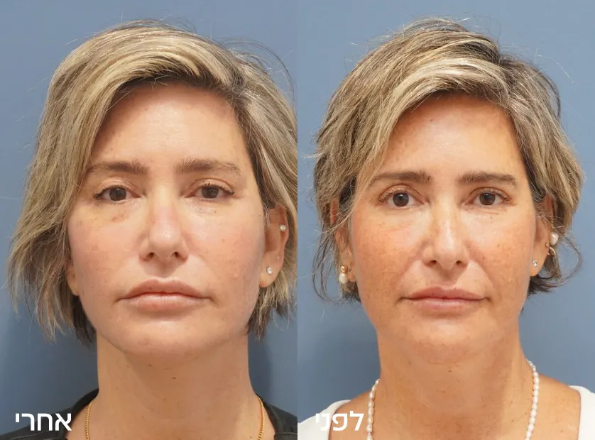 Before-After copy-4