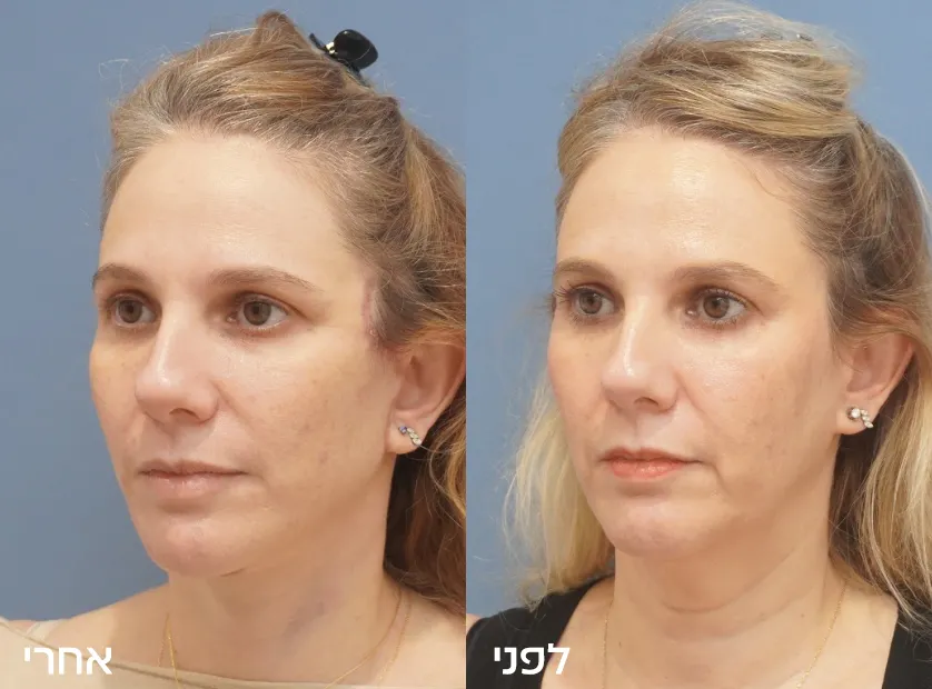 Before-After copy-5
